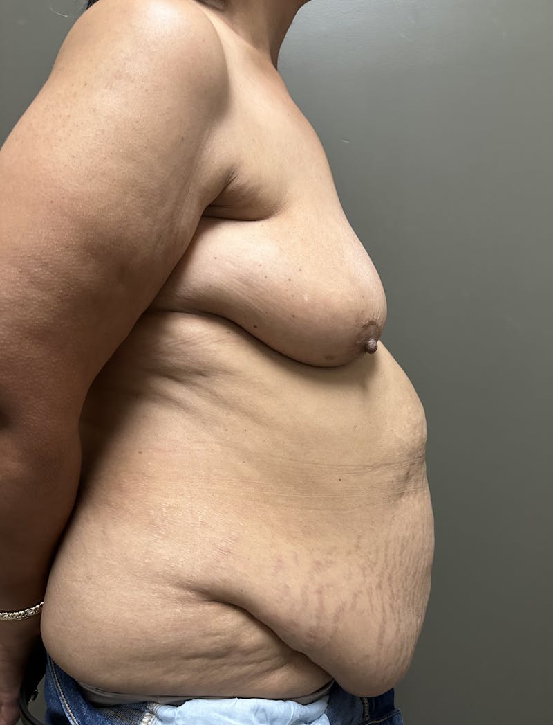 Combined Breast and Abdomen Before & After Gallery - Patient 426459 - Image 5