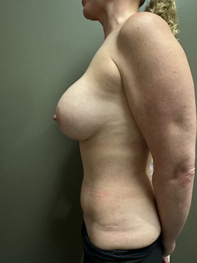 Combined Breast and Abdomen Before & After Gallery - Patient 381931 - Image 1