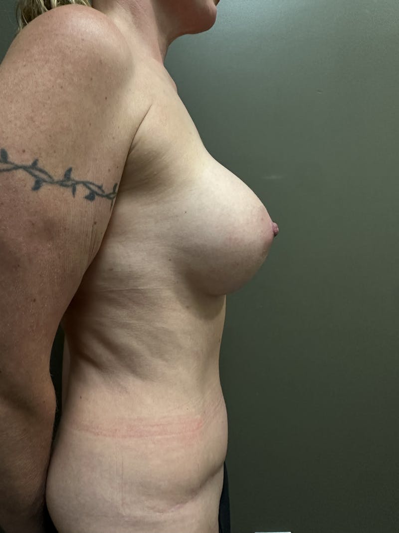 Combined Breast and Abdomen Before & After Gallery - Patient 381931 - Image 4