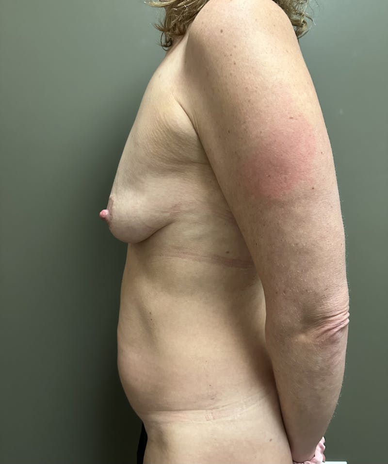 Combined Breast and Abdomen Before & After Gallery - Patient 381931 - Image 5