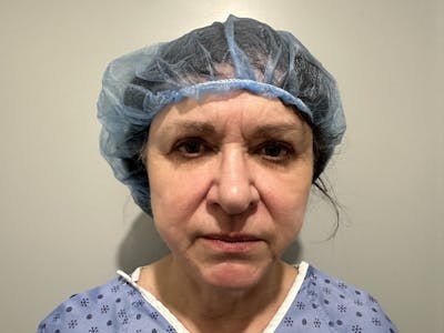 Face Before & After Gallery - Patient 877758 - Image 1