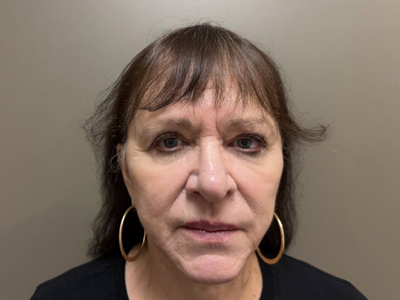 Face Before & After Gallery - Patient 877758 - Image 2