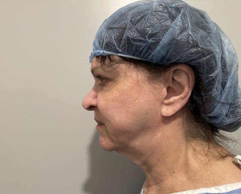 Face Before & After Gallery - Patient 877758 - Image 3