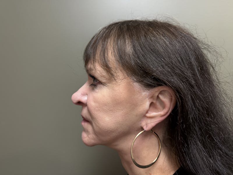 Face Before & After Gallery - Patient 877758 - Image 4