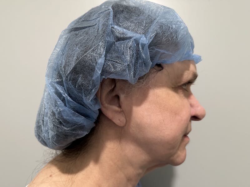 Face Before & After Gallery - Patient 877758 - Image 5