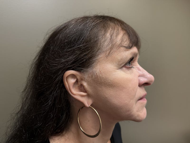 Face Before & After Gallery - Patient 877758 - Image 6