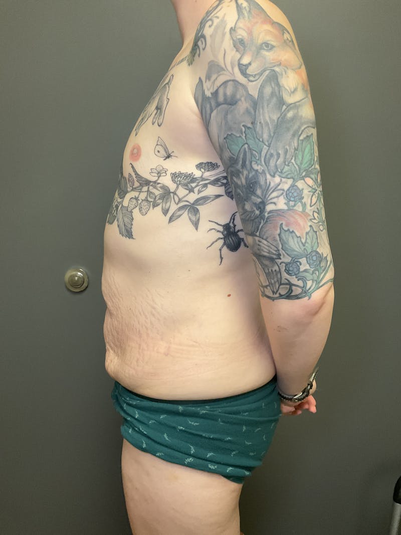 Abdominoplasty Before & After Gallery - Patient 348479 - Image 3