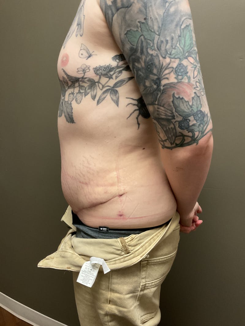 Abdominoplasty Before & After Gallery - Patient 348479 - Image 4