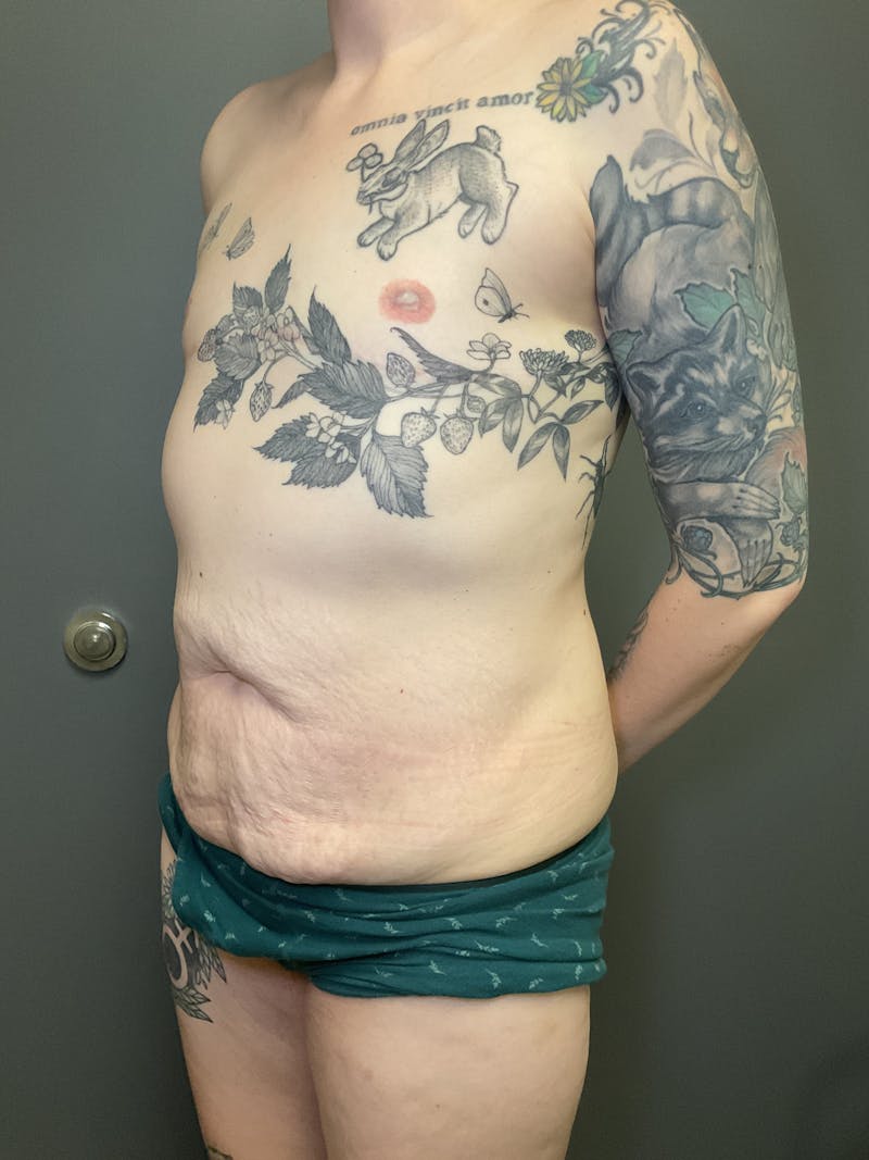 Abdominoplasty Before & After Gallery - Patient 348479 - Image 5