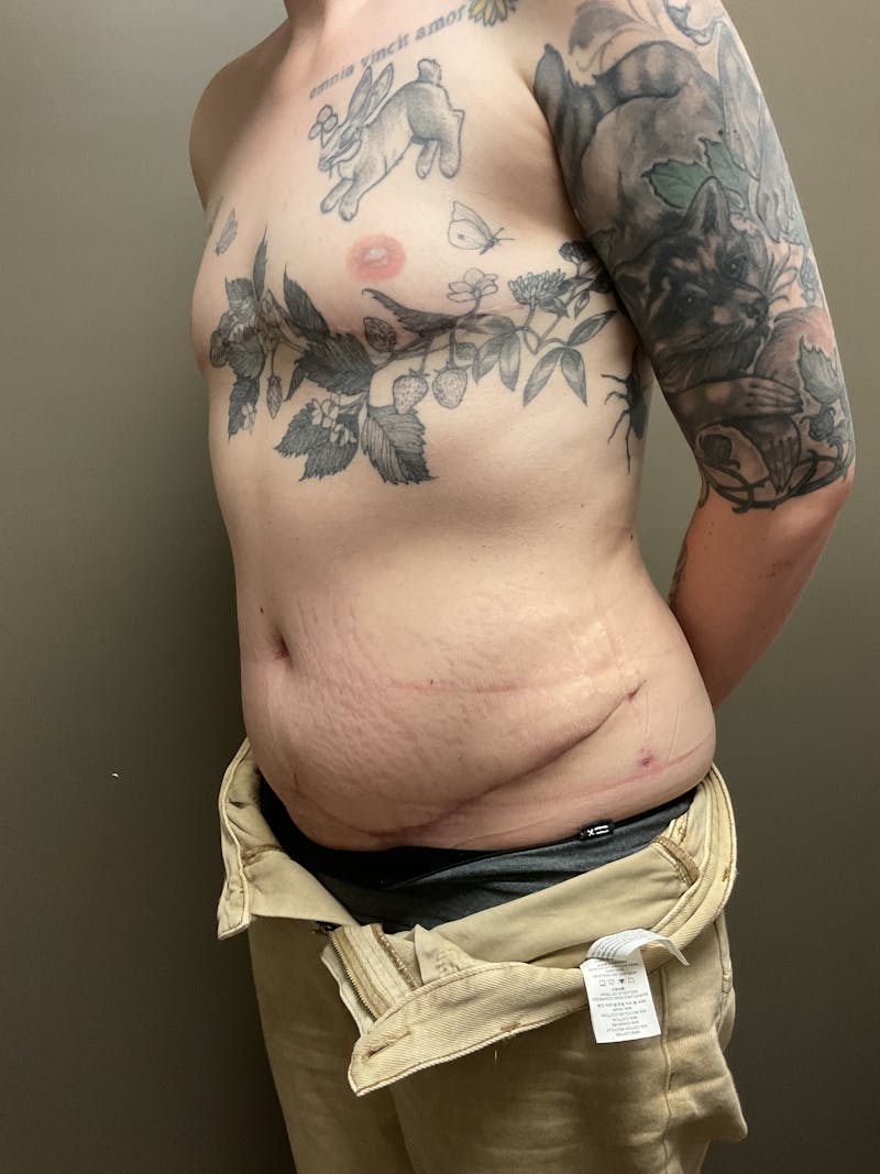 Abdominoplasty Before & After Gallery - Patient 348479 - Image 6