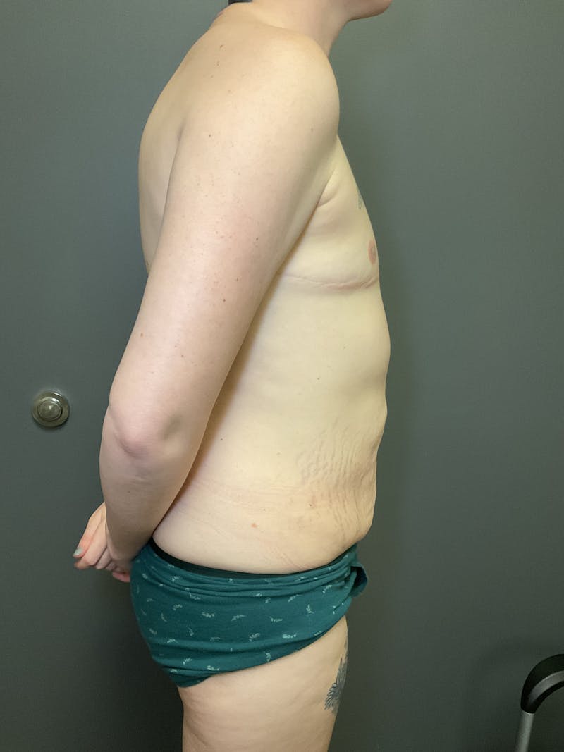 Abdominoplasty Before & After Gallery - Patient 348479 - Image 7