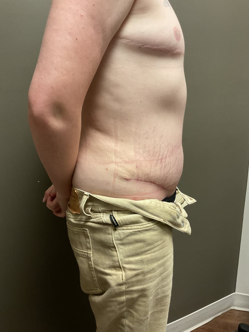 Abdominoplasty Before & After Gallery - Patient 348479 - Image 8