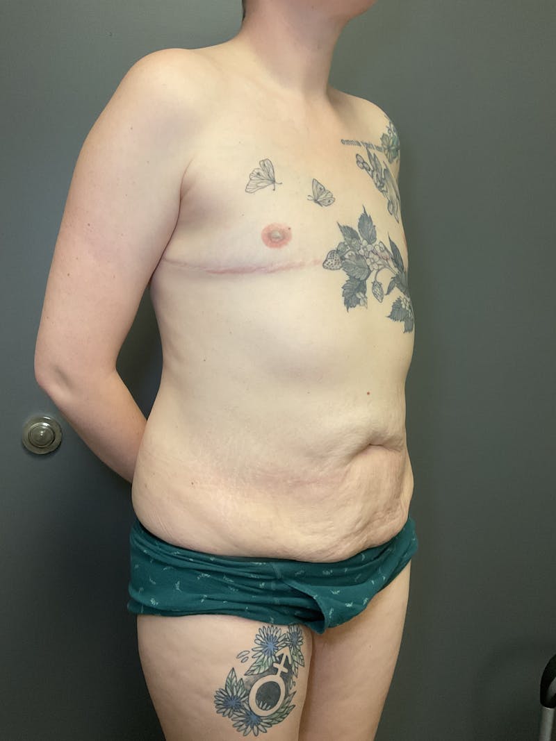 Abdominoplasty Before & After Gallery - Patient 348479 - Image 9