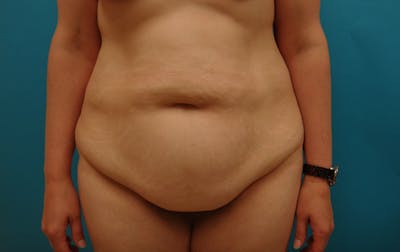 Abdominoplasty Before & After Gallery - Patient 158991 - Image 1