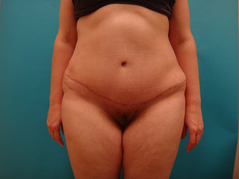 Abdominoplasty Before & After Gallery - Patient 158991 - Image 2
