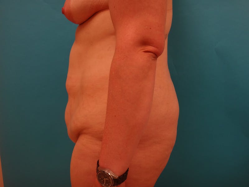 Abdominoplasty Before & After Gallery - Patient 158991 - Image 3