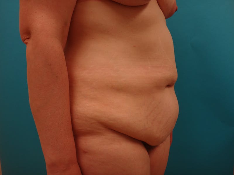 Abdominoplasty Before & After Gallery - Patient 158991 - Image 7