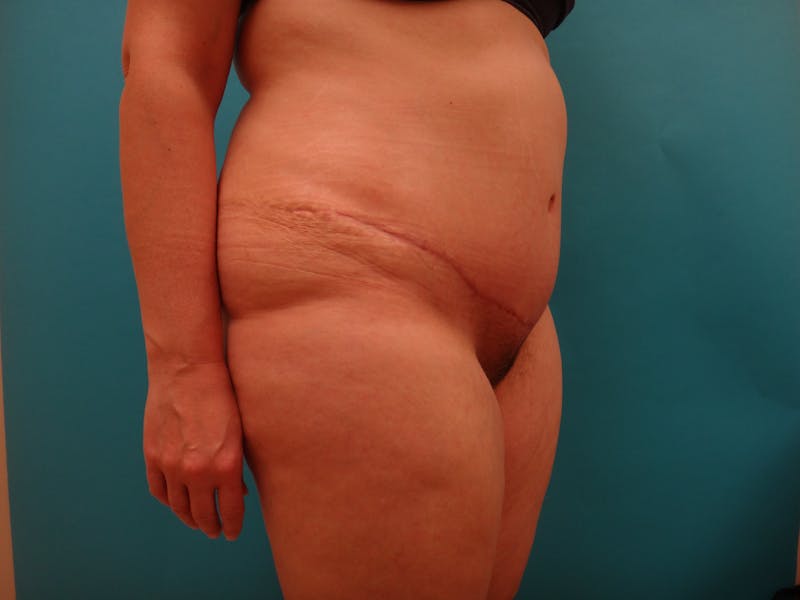 Abdominoplasty Before & After Gallery - Patient 158991 - Image 8