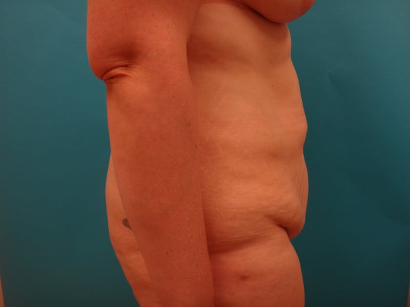 Abdominoplasty Before & After Gallery - Patient 158991 - Image 9