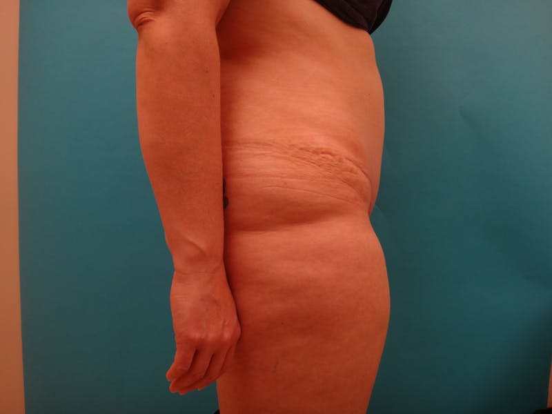 Abdominoplasty Before & After Gallery - Patient 158991 - Image 10