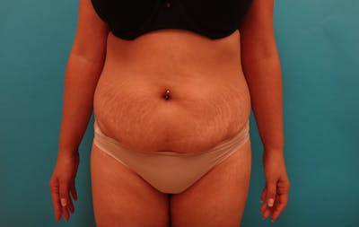 Abdominoplasty Before & After Gallery - Patient 333169 - Image 1