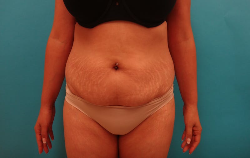Abdominoplasty Before & After Gallery - Patient 490935 - Image 1