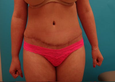 Abdominoplasty Before & After Gallery - Patient 333169 - Image 2