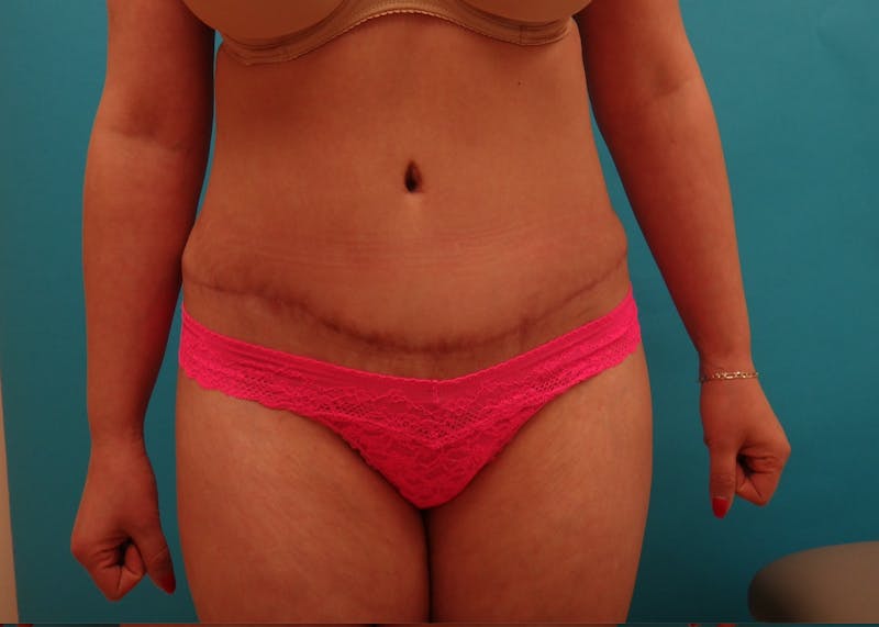 Abdominoplasty Before & After Gallery - Patient 490935 - Image 2