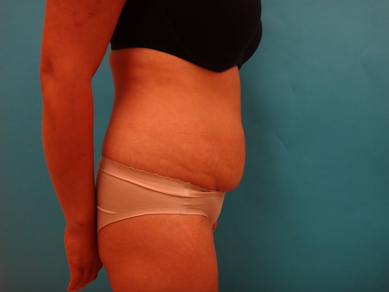 Abdominoplasty Before & After Gallery - Patient 490935 - Image 3
