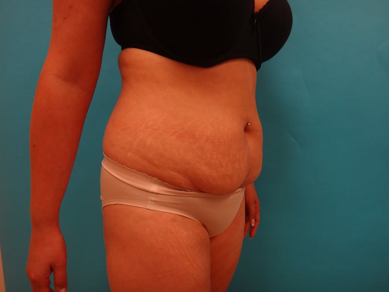 Abdominoplasty Before & After Gallery - Patient 490935 - Image 5