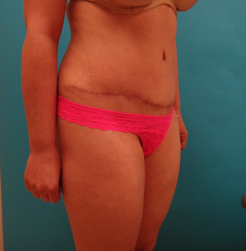 Abdominoplasty Before & After Gallery - Patient 490935 - Image 6