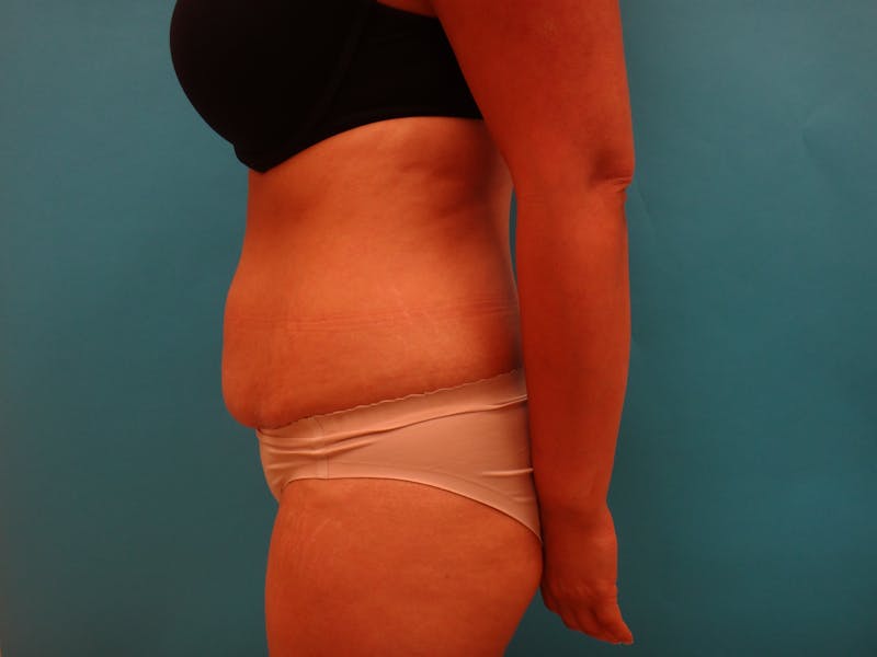Abdominoplasty Before & After Gallery - Patient 490935 - Image 7