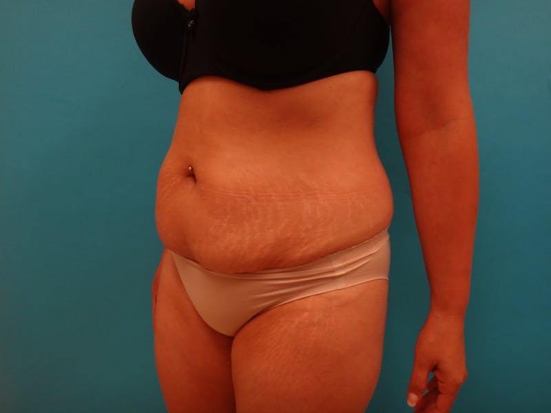 Abdominoplasty Before & After Gallery - Patient 490935 - Image 9