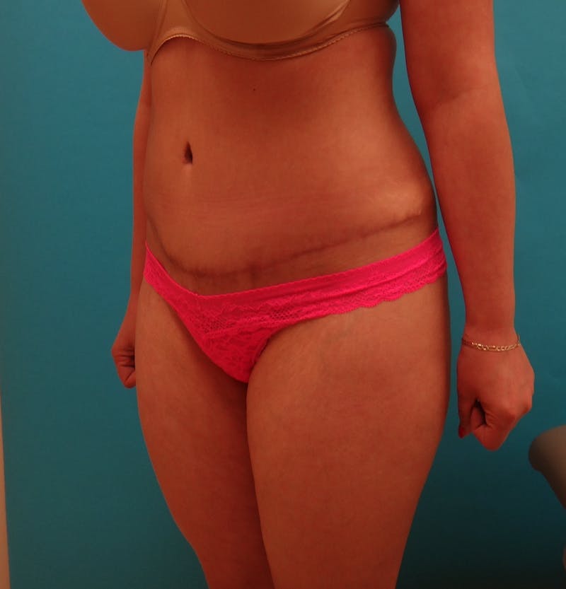Abdominoplasty Before & After Gallery - Patient 490935 - Image 10