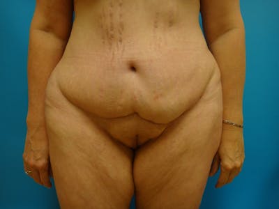 Abdominoplasty Before & After Gallery - Patient 100886 - Image 1