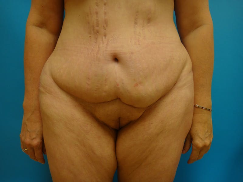 Abdominoplasty Before & After Gallery - Patient 100886 - Image 1