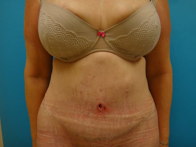 Abdominoplasty Before & After Gallery - Patient 100886 - Image 2