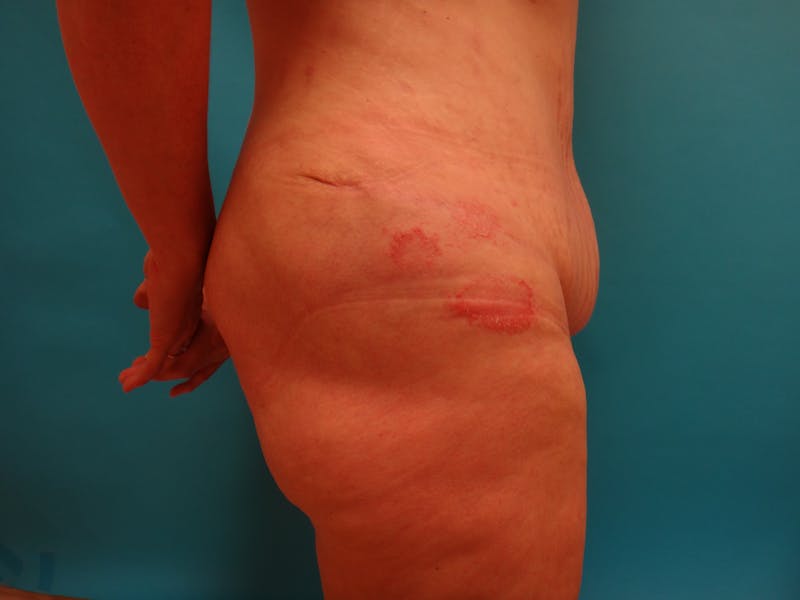 Abdominoplasty Before & After Gallery - Patient 100886 - Image 3