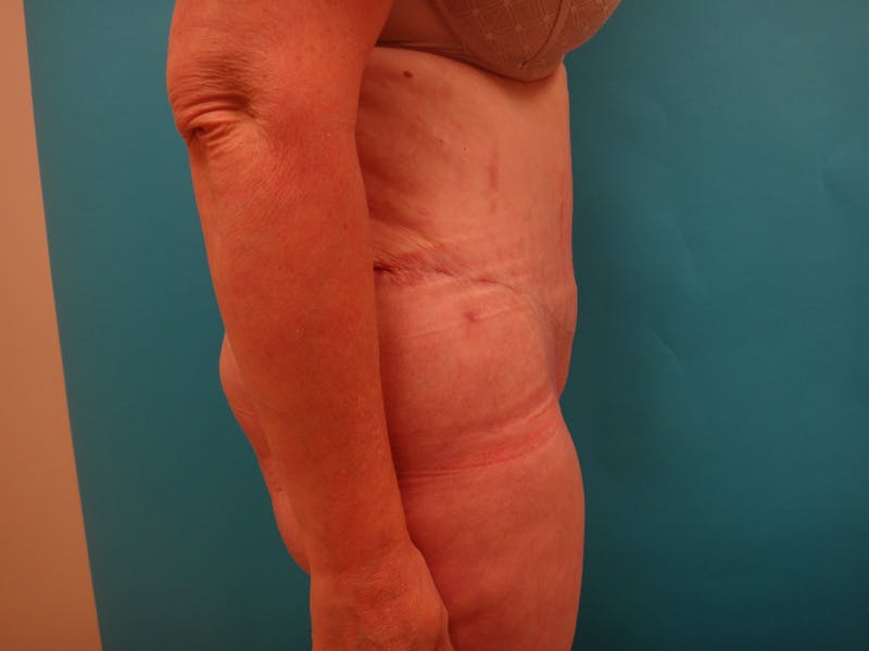 Abdominoplasty Before & After Gallery - Patient 100886 - Image 4