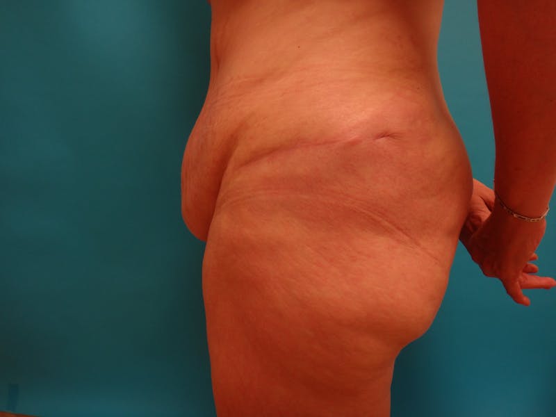 Abdominoplasty Before & After Gallery - Patient 100886 - Image 7