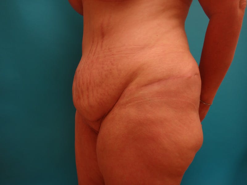 Abdominoplasty Before & After Gallery - Patient 100886 - Image 9
