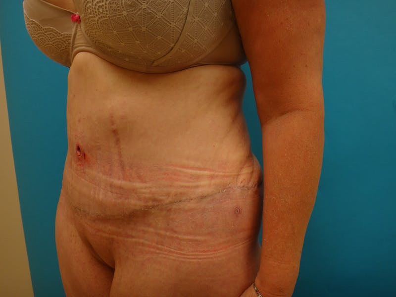 Abdominoplasty Before & After Gallery - Patient 100886 - Image 10