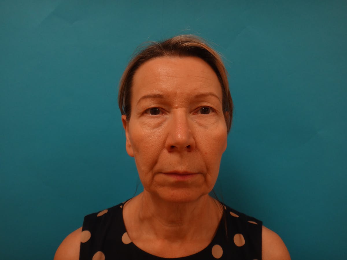 Blepharoplasty Before & After Gallery - Patient 241936 - Image 1