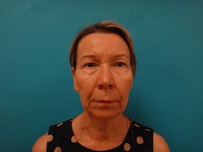 Blepharoplasty Before & After Gallery - Patient 241936 - Image 1