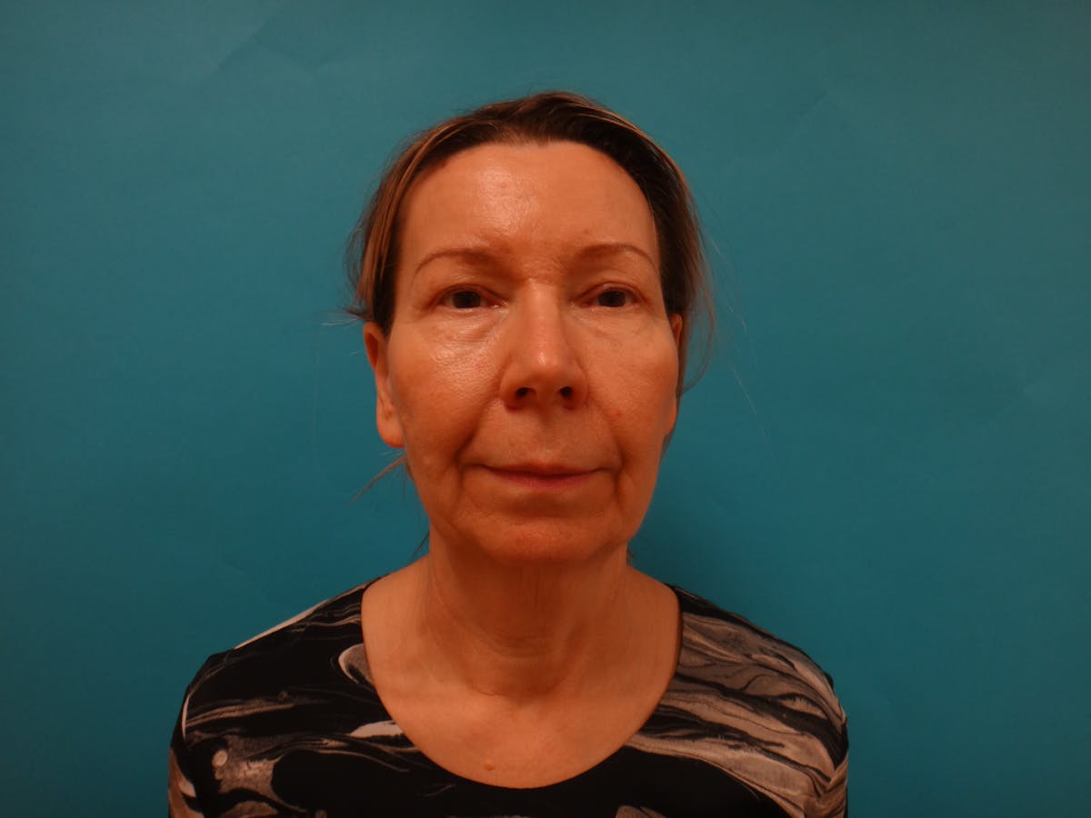 Blepharoplasty Before & After Gallery - Patient 241936 - Image 2