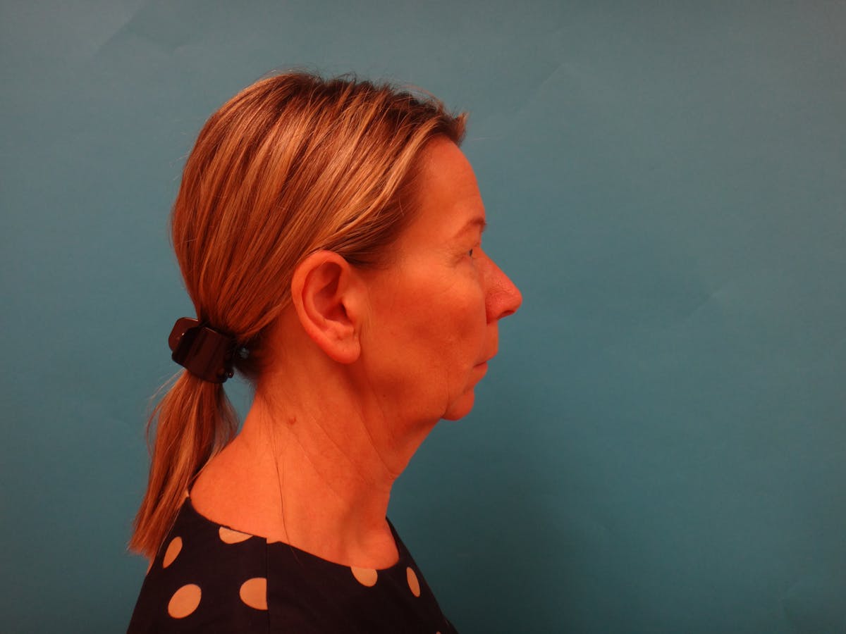 Blepharoplasty Before & After Gallery - Patient 241936 - Image 3