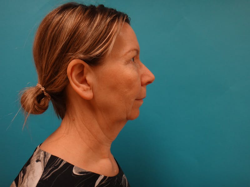 Blepharoplasty Before & After Gallery - Patient 293655 - Image 4