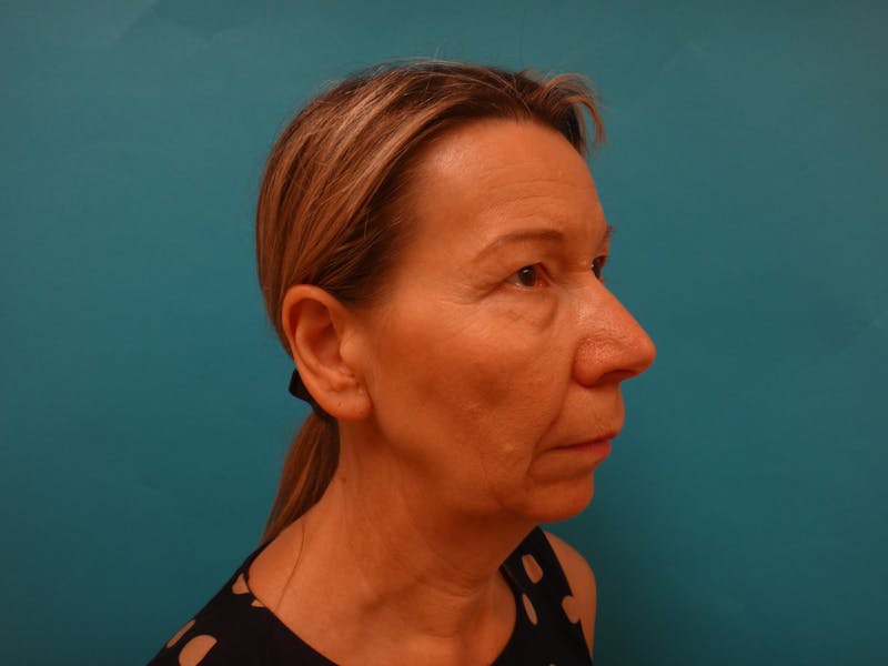 Blepharoplasty Before & After Gallery - Patient 293655 - Image 5
