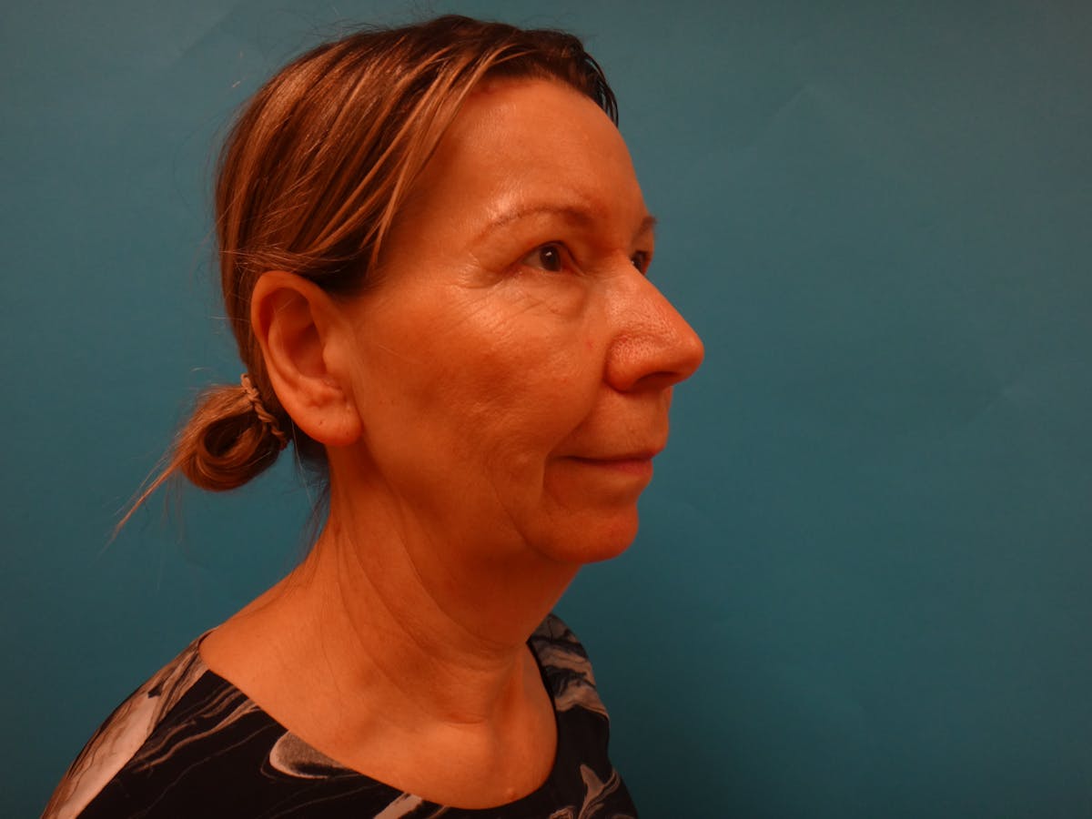 Blepharoplasty Before & After Gallery - Patient 241936 - Image 6