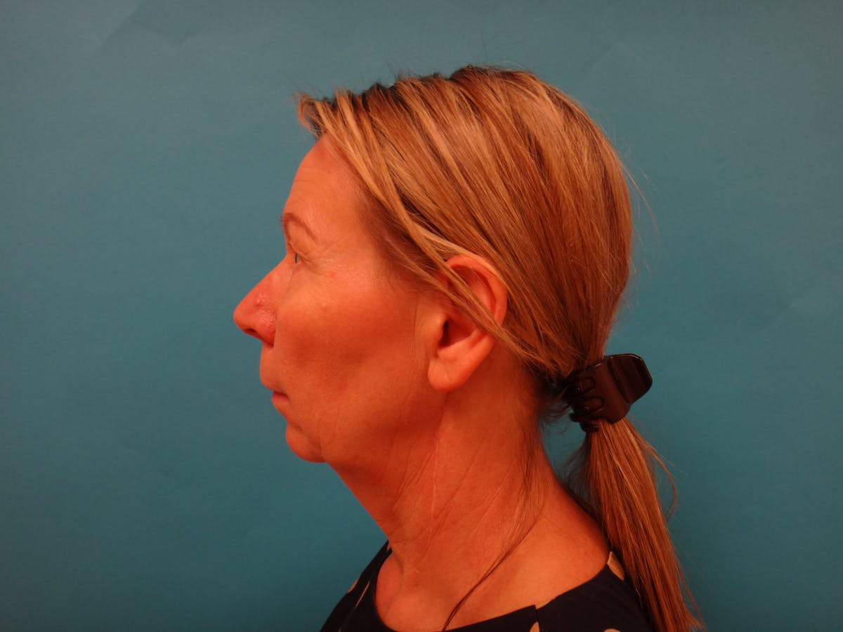 Blepharoplasty Before & After Gallery - Patient 241936 - Image 7